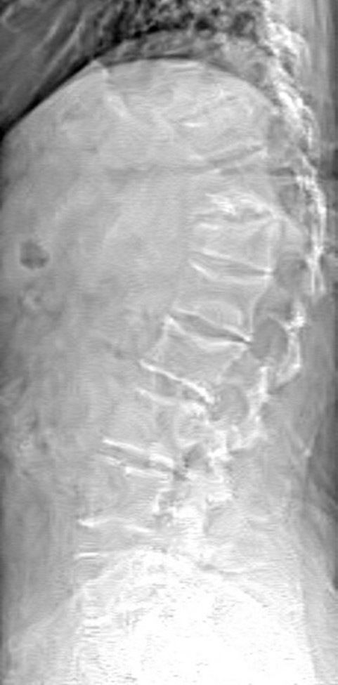 Osteoblastic cells growing in culture. Individual patient's cells have different morphology and growth rates.